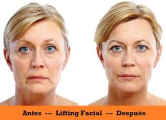Eliminar el Doble Mentón mediante LIFTING Facial Beneficios del Lifting Facial