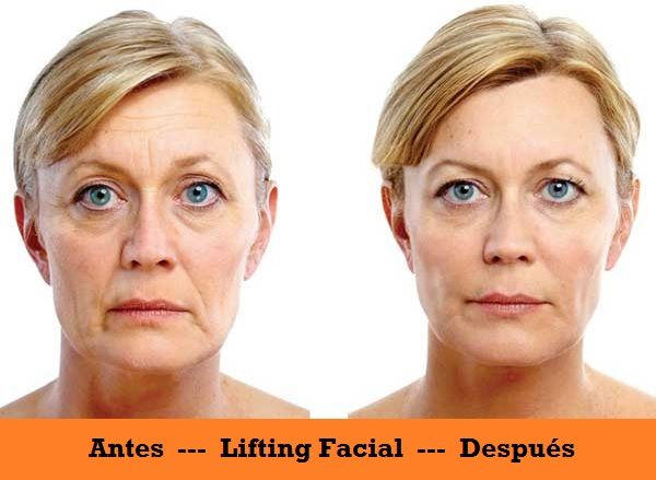 Beneficios del Lifting Facial
