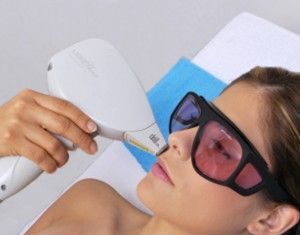 Depilación láser de la zona del bigote