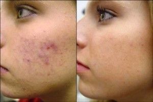 eliminar manchas de acné