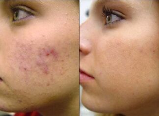 Como quitar las marcas provocadas por el acné eliminar manchas de acné