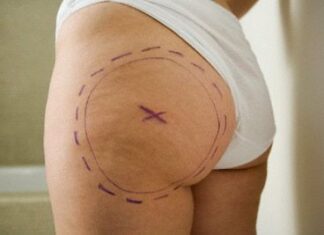 Problema de la celulitis