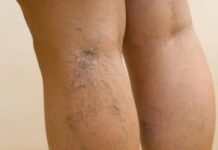 Varices:Factores que influyen en su desarrollo y Prevención.