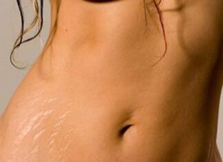 Ayuda con las Estrias, Cómo Disimularlas