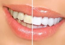 Dientes blancos y radiantes: naturalmente Dientes blancos y radiantes: naturalmente
