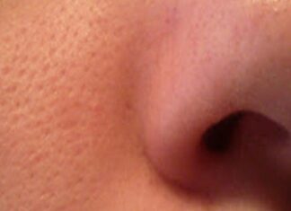 Poros Abiertos ¿Cómo Tratarlos?