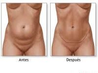 Abdominoplastia Mini