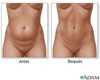 Abdominoplastia Mini