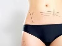 Técnicas de cirugía plástica mas utilizadas