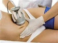 Cavitación para eliminar la grasa