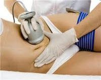 Cavitación para eliminar la grasa