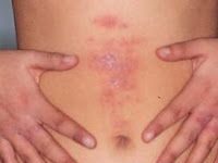 Dermatitis de contacto