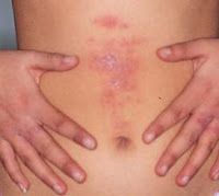 Dermatitis de contacto