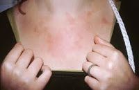 Evitar la Fotosensibilidad