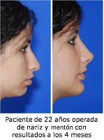 La Rinoplastia o Cirugía de Nariz