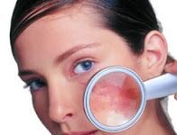Melasma