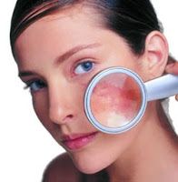 Melasma