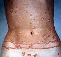 Psoriasis