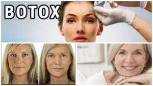 Cirugia con Botox