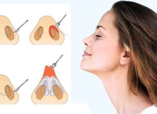 ¿Qué es una RINOPLASTIA y cuándo deberías aplicarla? Rinoplastia