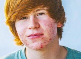 Consejos para COMBATIR EL ACNÉ