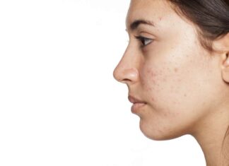 5 consejos para tratar el ACNÉ