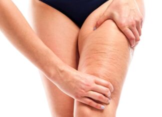 4 consejos para COMBATIR LA CELULITIS