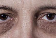 Ojeras, trucos para combatirlas