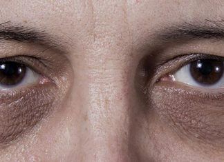 Ojeras, trucos para combatirlas