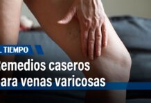 Remedios caseros para las VARICES
