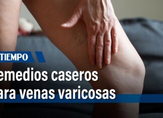 Remedios caseros para las VARICES