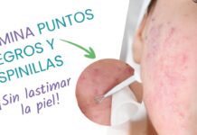 Cómo eliminar las ESPINILLAS ✨ Tratamiento del acné