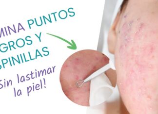 Cómo eliminar las ESPINILLAS ✨ Tratamiento del acné